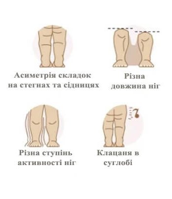Дисплазія