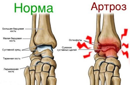  развитие артроза в голеностопном суставе 