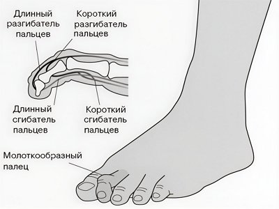 Молоткообразная деформация пальцев стопы