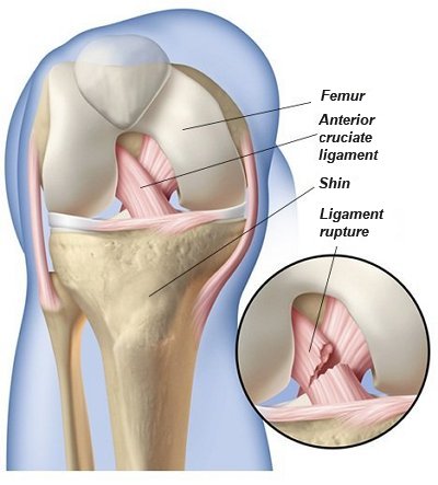 Anterior Cruciate Ligament Tear