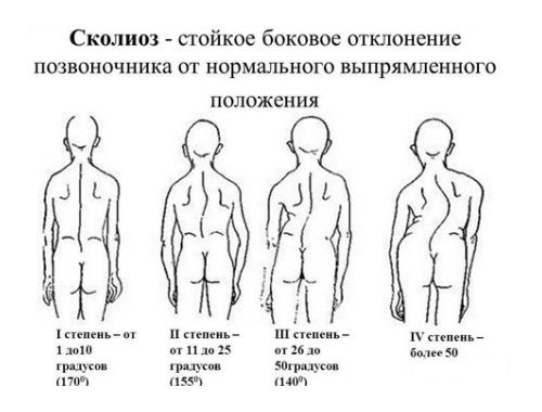 степени сколиоза