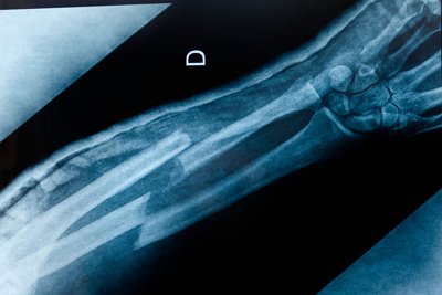 Treatment of displaced bone fractures