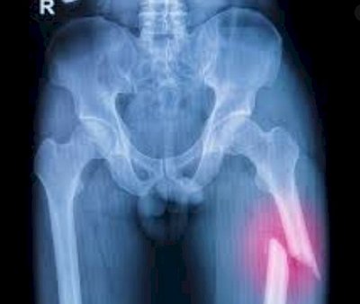 Treatment of displaced bone fractures