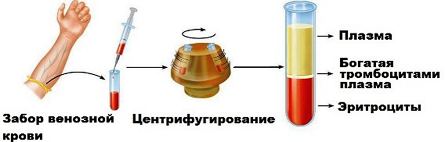 Что же такое PRP-терапия